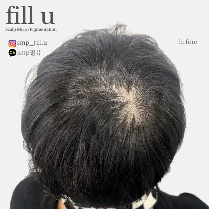 남성 정수리 두피문신 SMP