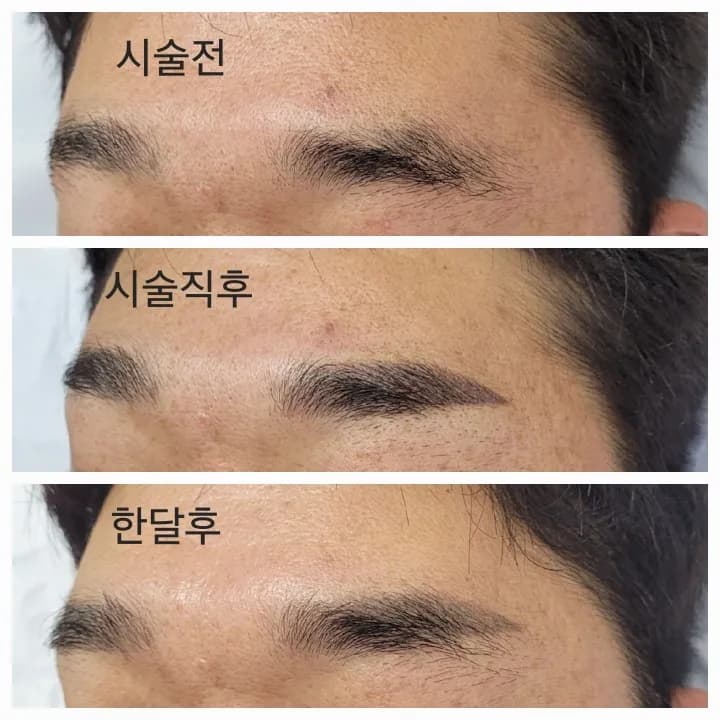 남자눈썹 시술직후