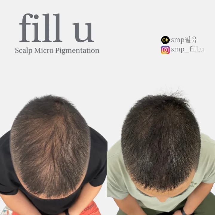 정수리 탈모 커버 SMP 두피문신