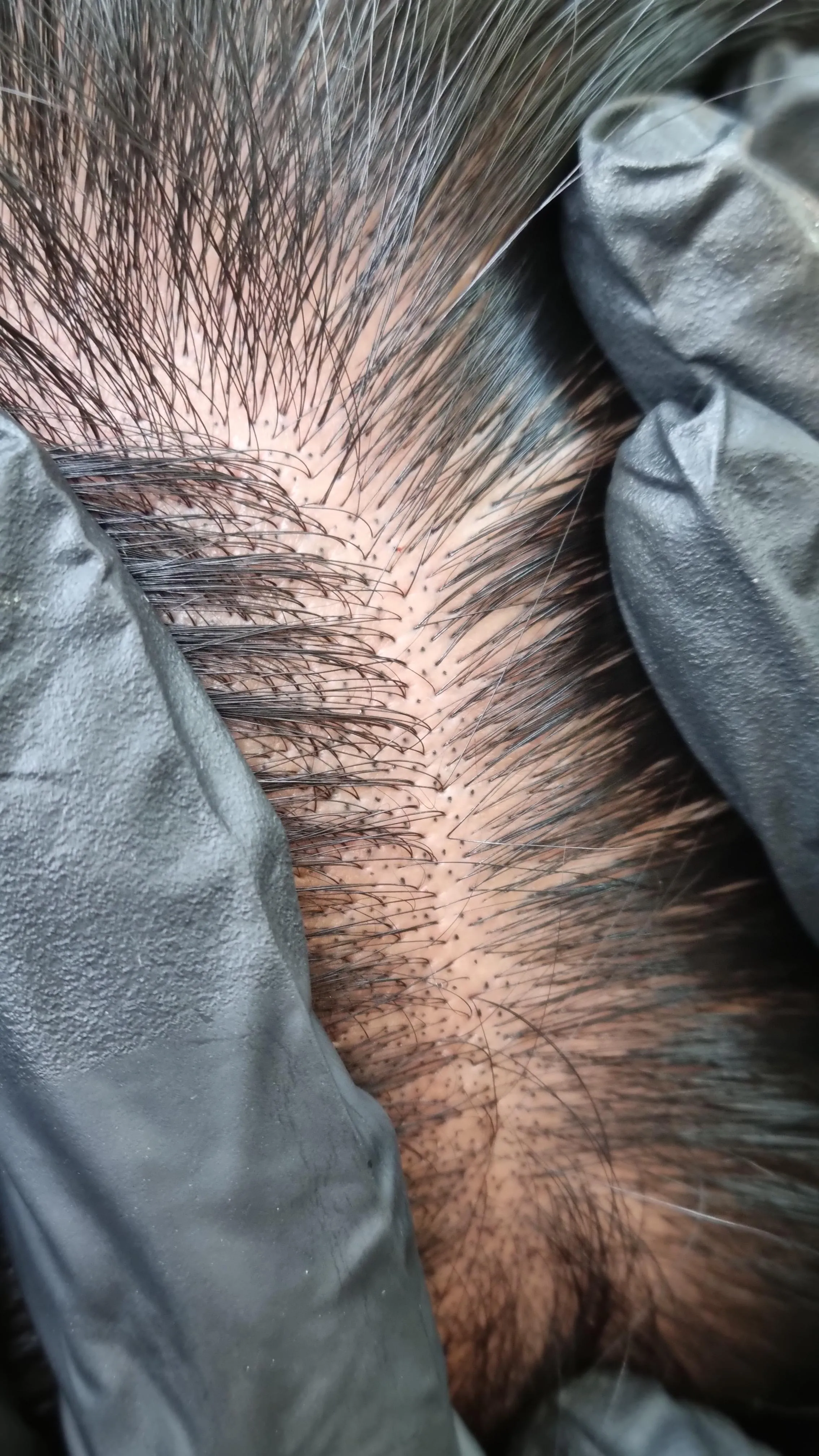 남성 가르마숱보강 시술입니다. - 1