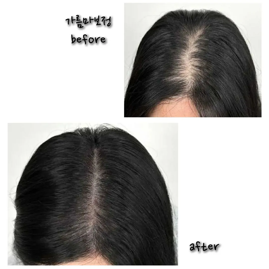 가르마탈모커버