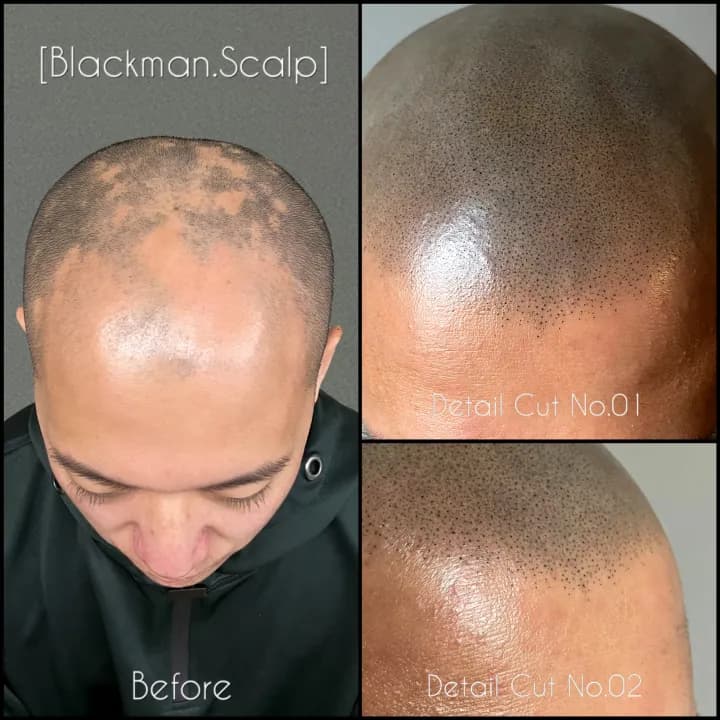 원형탈모커버 삭발 두피문신