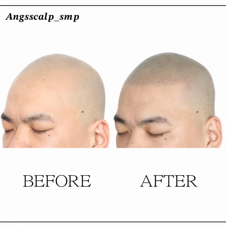 민머리 전체탈모 두피문신