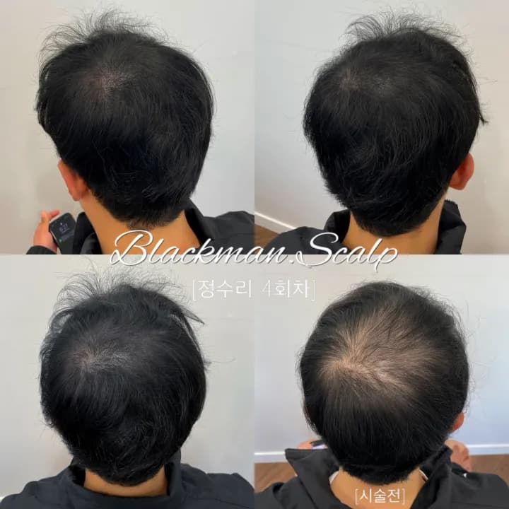 정수리 가르마 두피문신