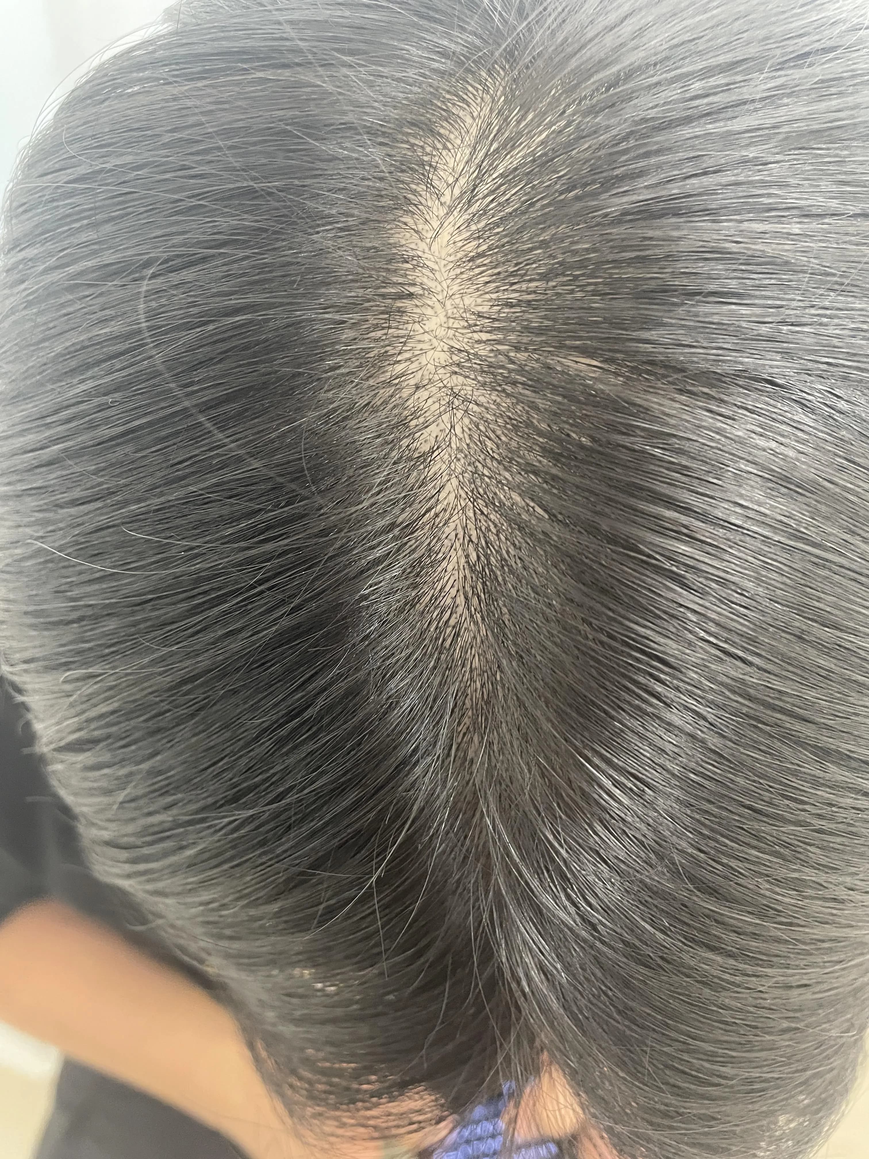 남성가르마 숱보강 - 1