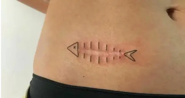 상처가 너무커서 보기 흉하다면???